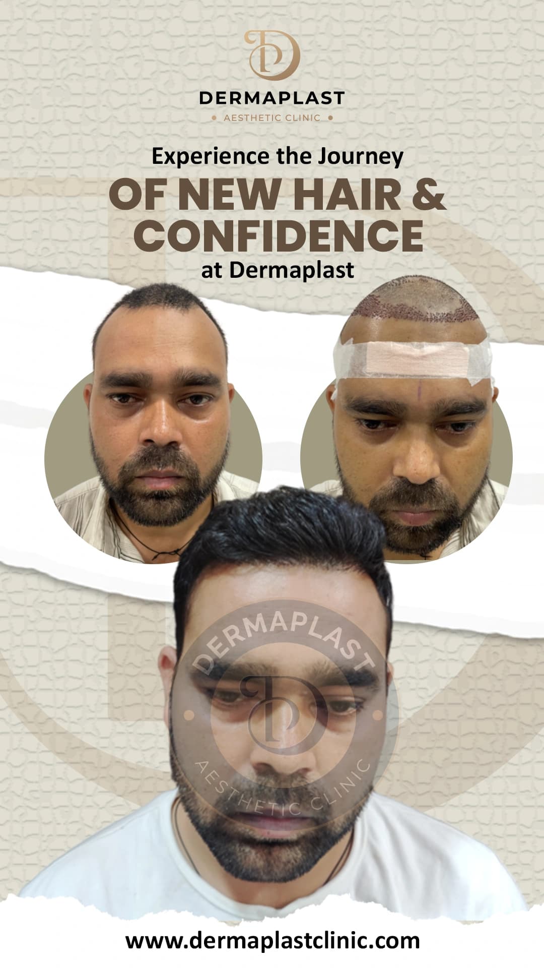 Hair transplant result at Dermaplast — case 3 of 6: the same patient before the procedure, immediately after, and at follow-up. Procedure 18 June.