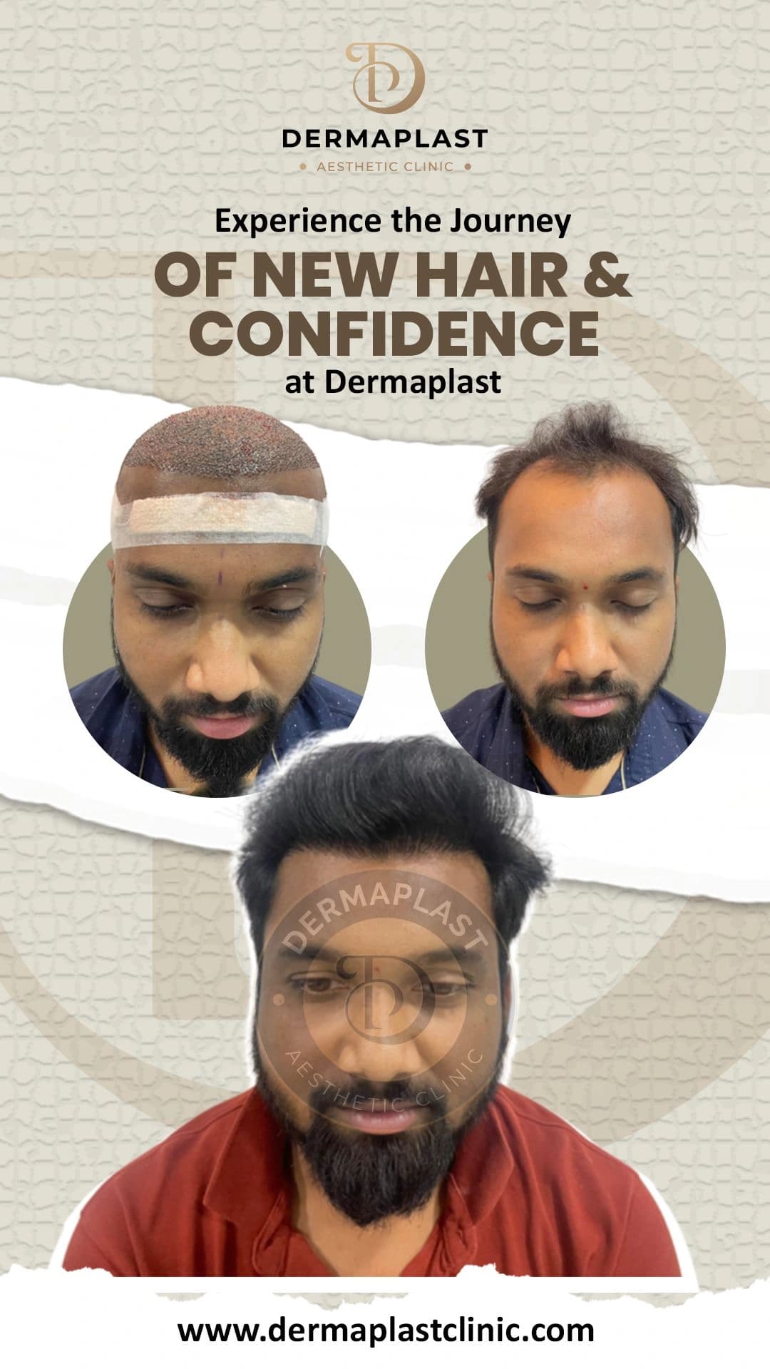 Hair transplant result at Dermaplast — case 5 of 6: the same patient before the procedure, immediately after, and at follow-up. Procedure 3 August.