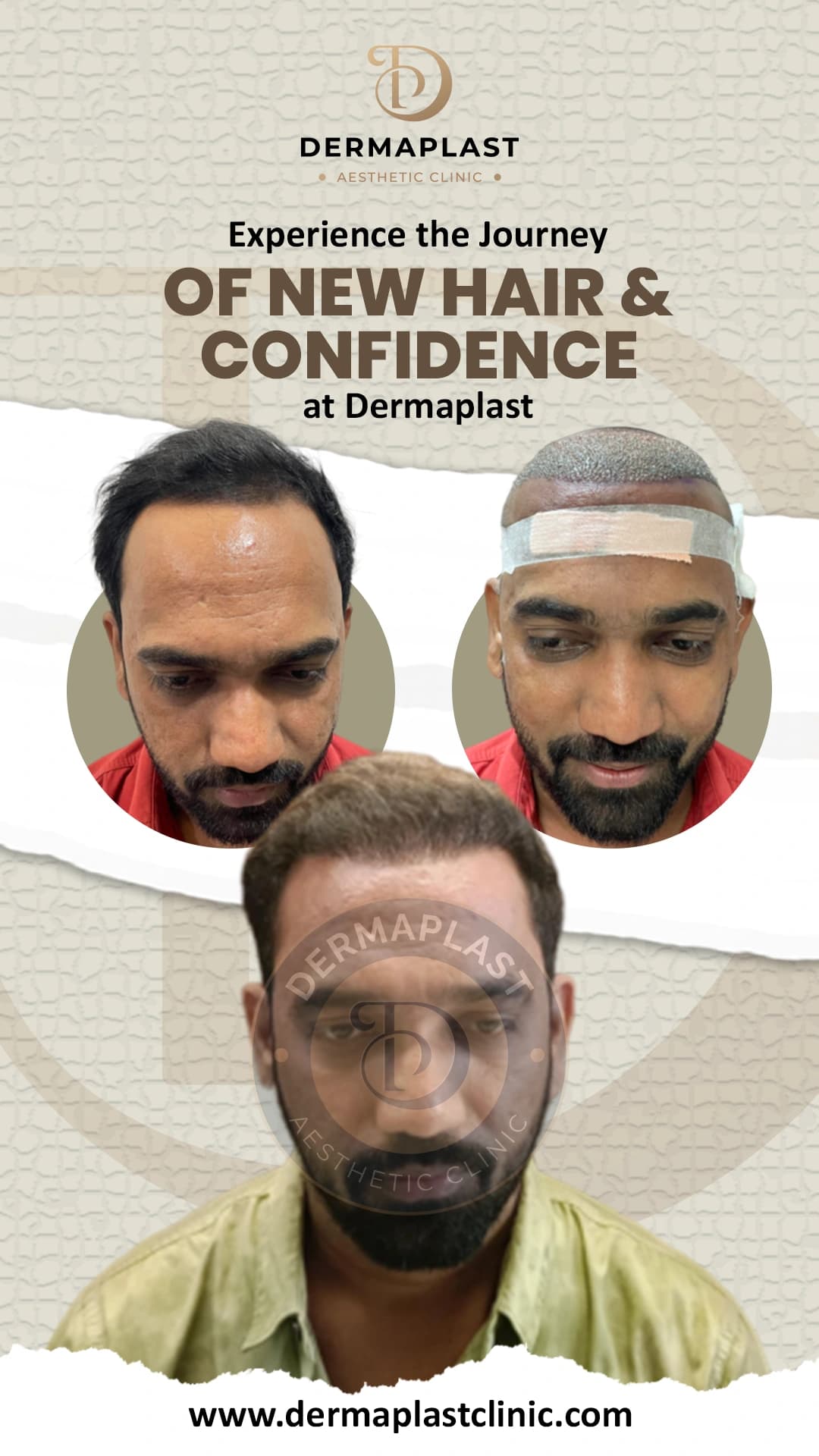Hair transplant result at Dermaplast — case 7 of 12: the same patient before the procedure, immediately after, and at follow-up. Procedure 6 March.