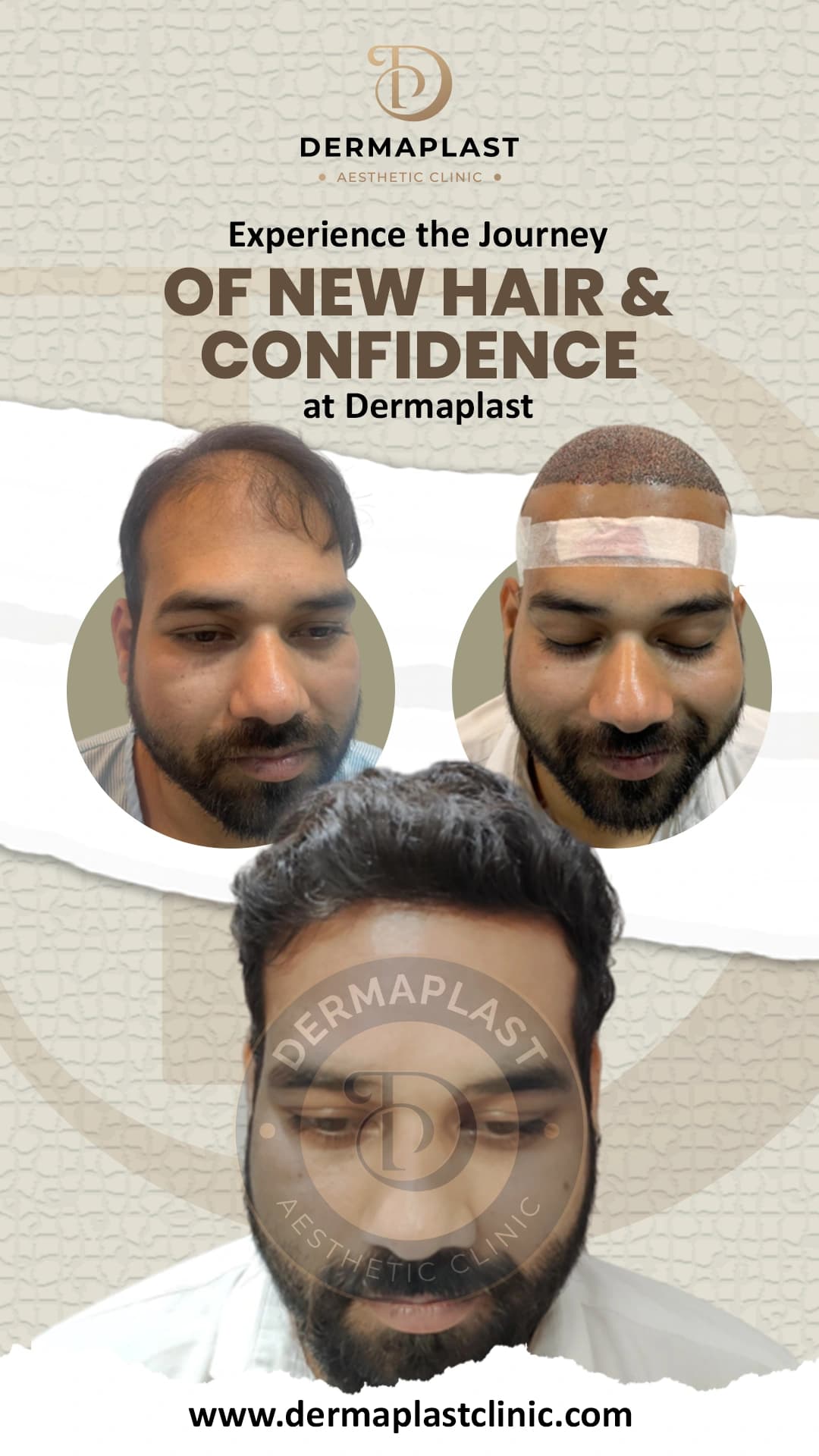 Hair transplant result at Dermaplast — case 9 of 12: the same patient before the procedure, immediately after, and at follow-up. Procedure 27 March.
