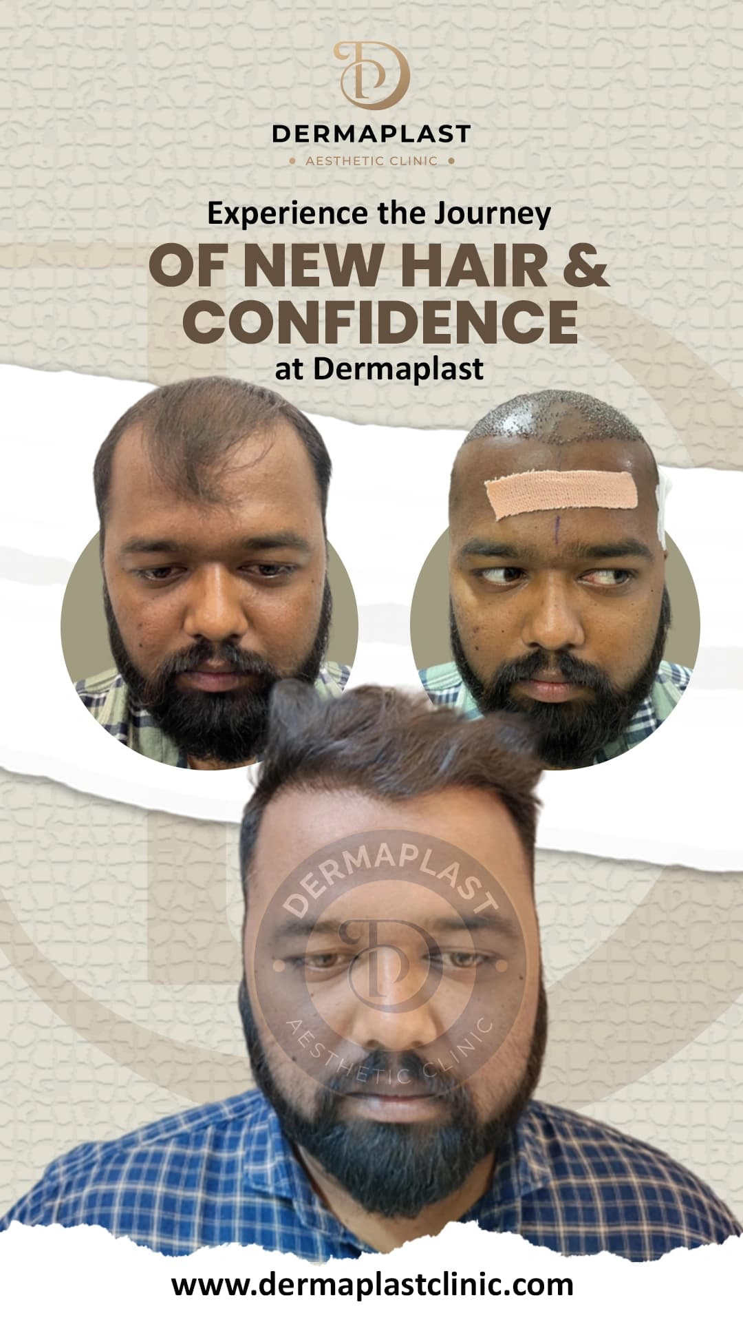 Hair transplant result at Dermaplast — case 11 of 12: the same patient before the procedure, immediately after, and at follow-up. Procedure 23 March 2024.