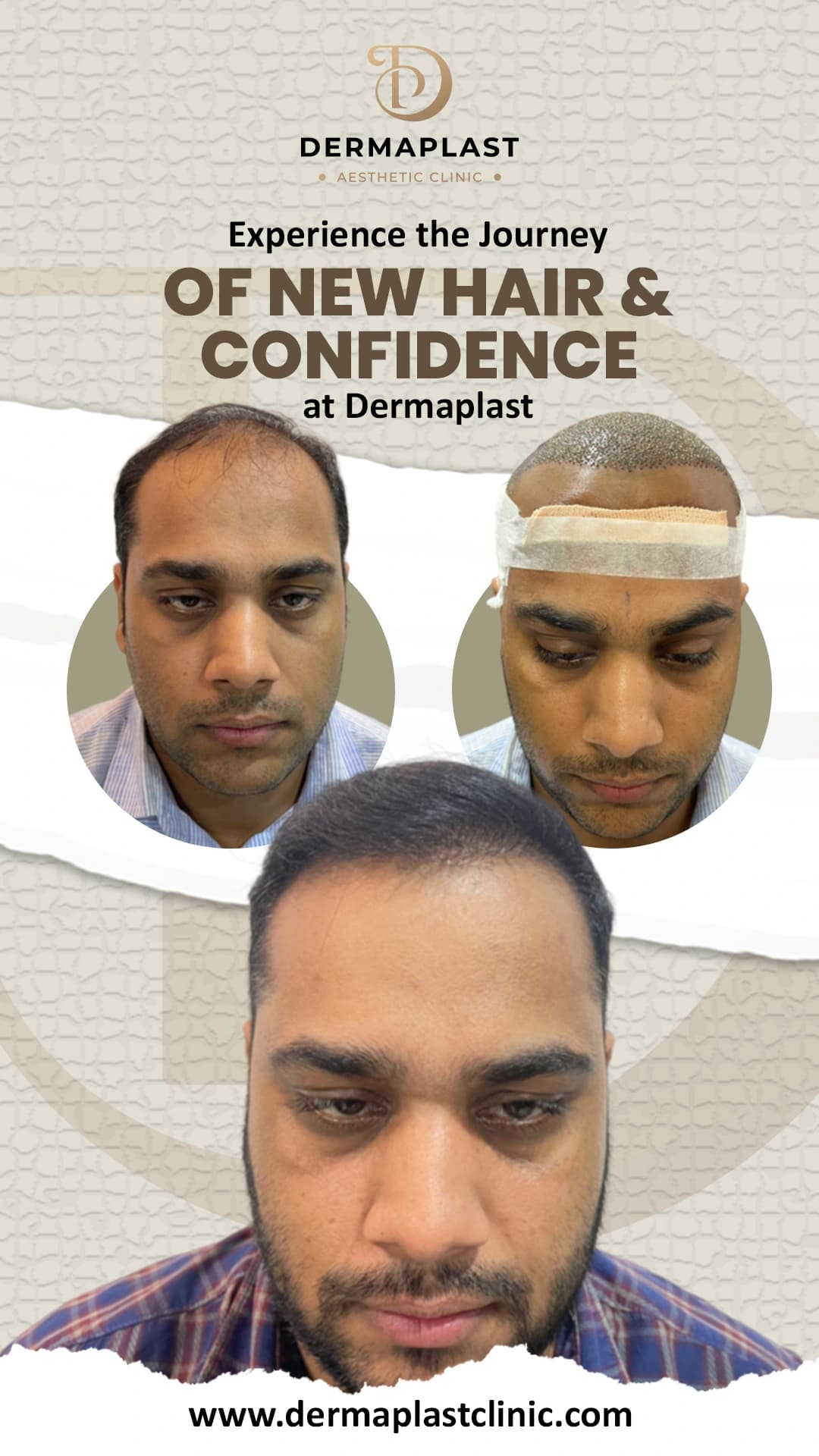 Hair transplant result at Dermaplast — case 12 of 12: the same patient before the procedure, immediately after, and at follow-up. Procedure 27 April.